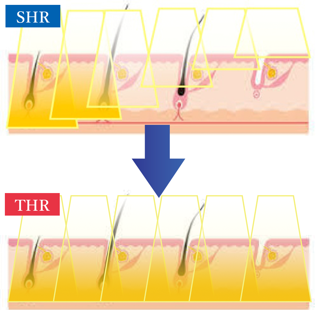 THR脱毛方式 CLEAR/SP-efの性能・機能 | 業務用脱毛機メーカー株式会社NBS