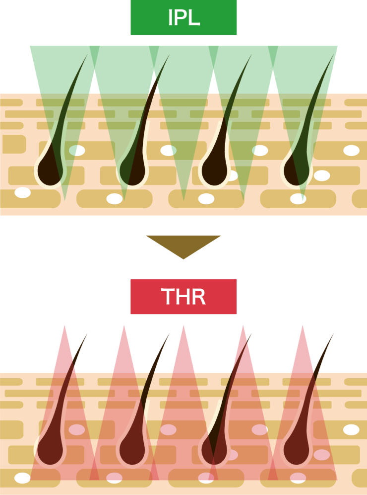 SHRとTHRの図